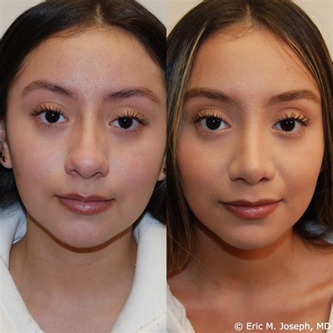 Eric M. Joseph, MD | Rhinoplasty Before & After: Wide Tip Reduction