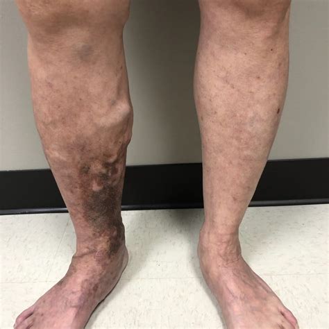 Leg Discoloration - Vein Institute - Surgical Associates of Houston