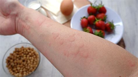 What's Causing My Eczema? 10 Common Triggers : Catherine Fuller, MD ...