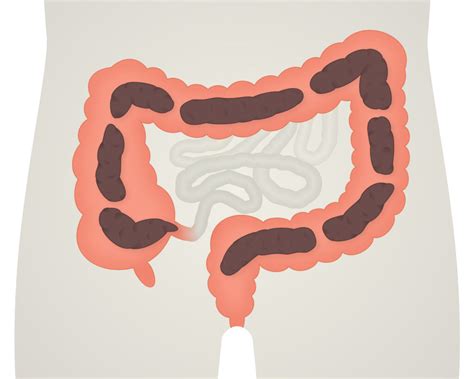 Understanding bowel irrigation - Qufora