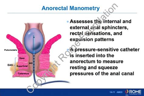 Anorectal 11 – Anorectal Manometry – Rome Online