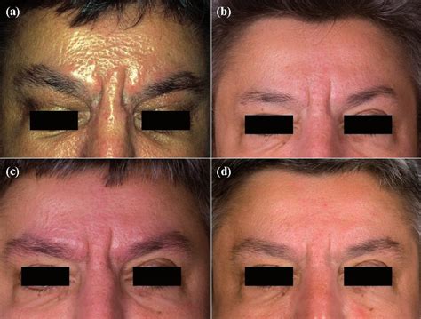 (a) This patient showed strong induration of the skin and lichenoid ...