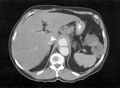 Celiac Arterial Aneurysms: A Critical Reappraisal of a Rare Entity | JAMA Surgery | JAMA Network