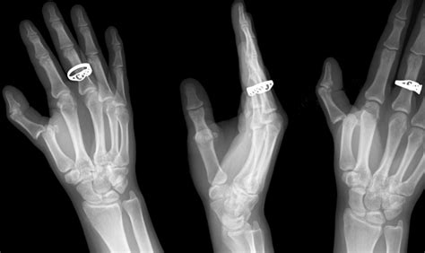 FINGER-THUMB DISLOCATION | Buyxraysonline