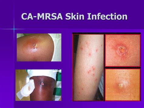 What Is Mrsa Infection