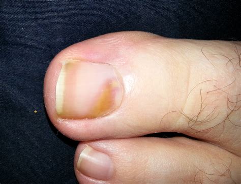 melanoma under toenail - pictures, photos