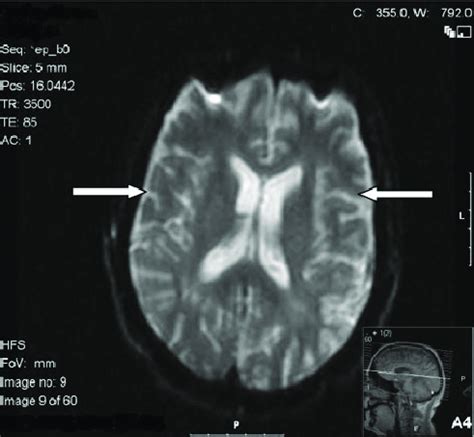 Axial view of diffusion-weighted MrI images on presentation shows ...