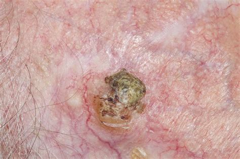 Skin Cancer Spots On Scalp
