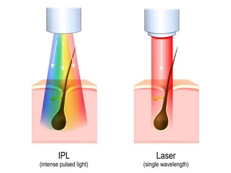 Diode Laser vs IPL: Which is the Best for Hair Removal?- konmison