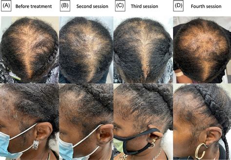 Transitory hair growth using platelet‐rich plasma therapy in stabilized central centrifugal ...