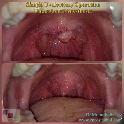 Uvula Pulling To One Side - mapageprek