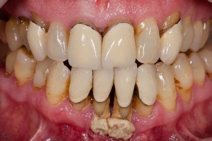 Gum Disease Treatment | Dentist in Sylmar, CA
