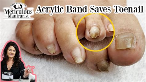 How to Fix a Pincer Toenail with Acrylic Journey - YouTube