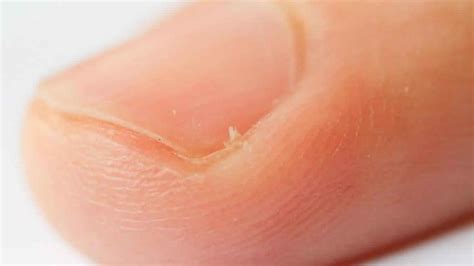 Hangnail & infected hangnail causes, symptoms, diagnosis & treatment