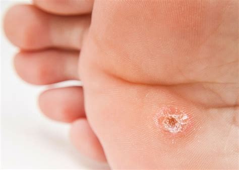 Hyperkeratosis: What is it? Causes, Types, Symptoms and Treatment - Scope Heal