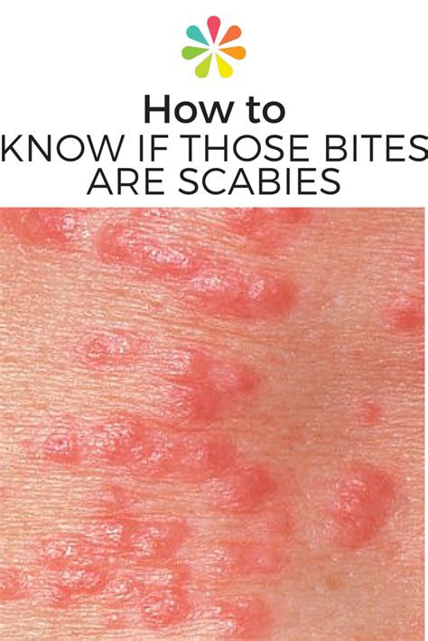 How To Identify Scabies Rash Scabies Rash Scabies Skin Rashes Pictures ...