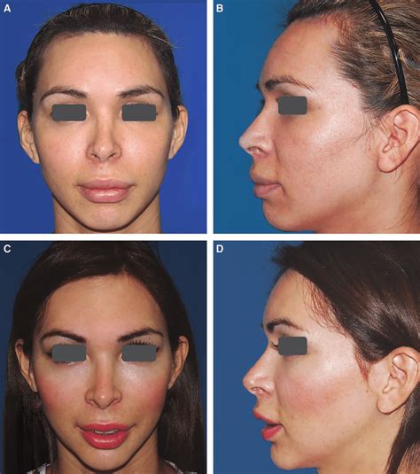 Results of supraorbital ridge shaving with hair transplantation:... | Download Scientific Diagram