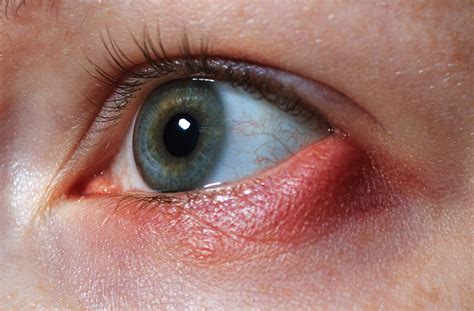 Stye: Causes, Symptoms, Treatment & Preventive Measures