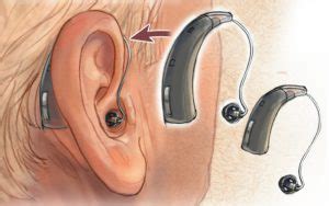 Receiver In Canal (RIC) Hearing Aids - Features, Price & Advantages