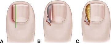 Ingrown toenail surgery | Podiatric Surgeon Perth | Dr Ned Buckley