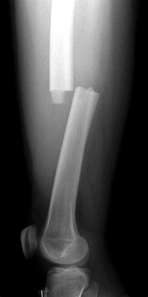 Femur Shaft Fractures (Broken Thighbone) - OrthoInfo - AAOS