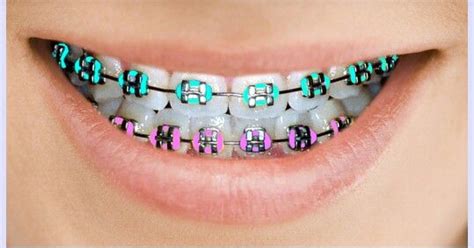 How To Pick The Best Braces Colors For Your Teeth - stpartysday