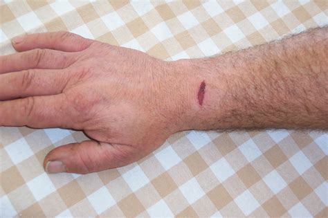 Gash Wound On Arm Free Stock Photo - Public Domain Pictures
