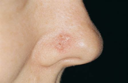 How To Detect Skin Cancer On Nose: Symptoms Of Skin Cancer On Nose