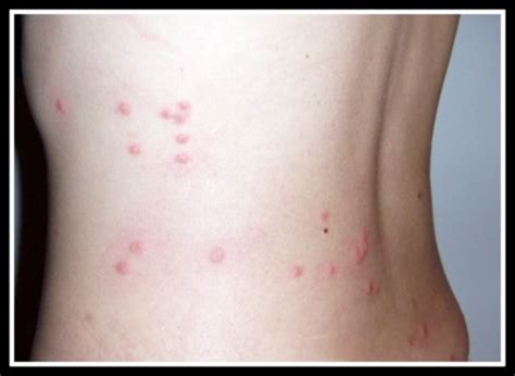 How To Get Rid Of Red Flea Bite Marks at Christopher Knowlton blog