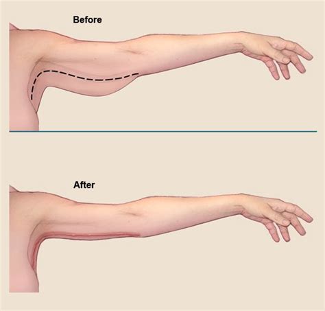 New Jersey | Arm lift surgery, Skin removal surgery, Body lift surgery