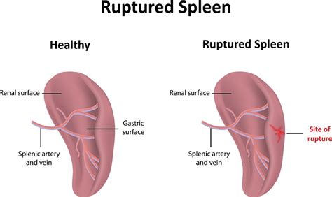 Treatment Options For A Ruptured Spleen | Dr. Michael Koeplin