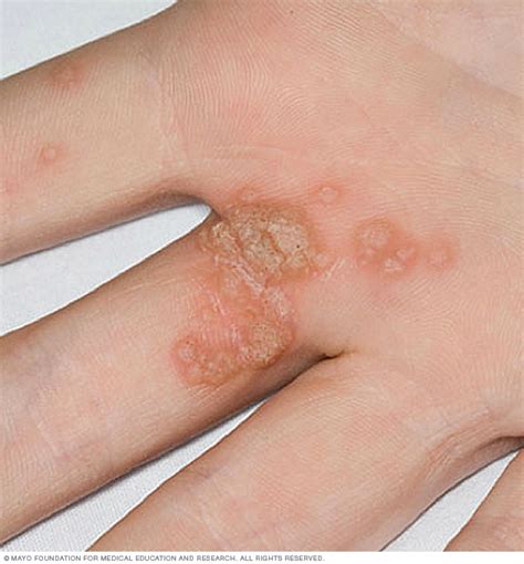 Common warts Disease Reference Guide - Drugs.com