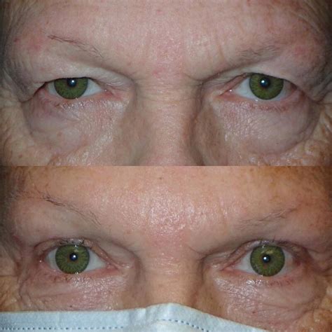 Brow Ptosis Repair - Cameron Nabavi, MD