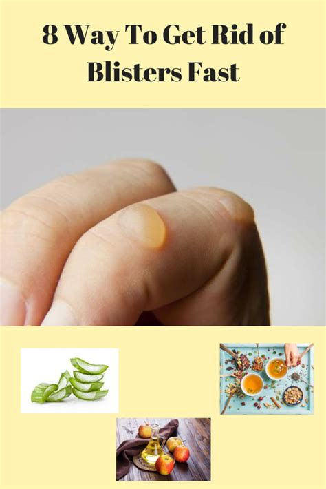 Best 8 Way To Get Rid of Blisters Fast - Blisters Treatment (With images) | Blister treatment ...