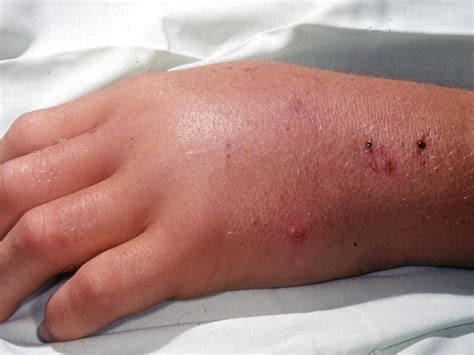 How to identify snake, spider bites: Australia’s most common stings | Gold Coast Bulletin