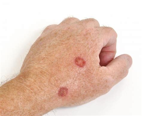 Figo! 15+ Elenchi di Melanoma Skin Cancer On Finger? Sunlight contains ultraviolet light that is ...