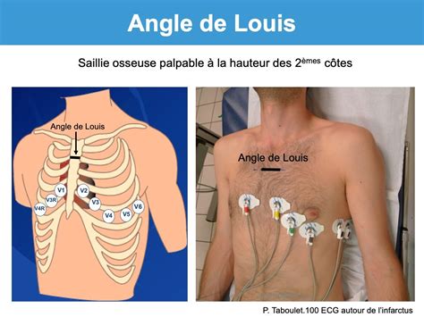 Angle de Louis : e-cardiogram