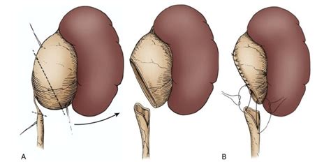 Pyeloplasty: Laparoscopic, Robotic, and RetroperitonealSurgery for Kids....so that every child ...