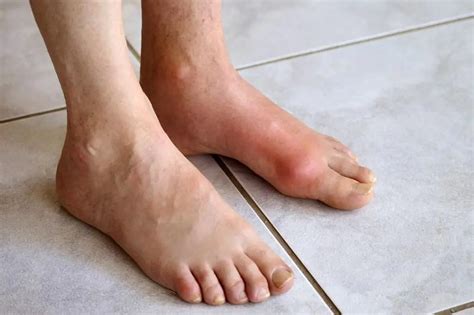 How to treat gout on the big toe: photos, symptoms and treatment methods | Health 2023