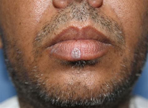 Isolated lichen planus of lip: Diagnosis and treatment monitoring using dermoscopy - Mathur ...