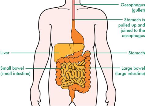 Surgery for oesophageal cancer - Information and support - Macmillan Cancer Support