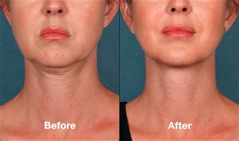 kybella-neck-fat-reduction - prettyfacemedispa.com