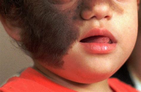 Werewolf syndrome: Babies in Spain develop rare disease after taking ...