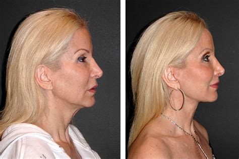 Facelift Scarring | How to Avoid Facelift Scars | No Facelift Scars