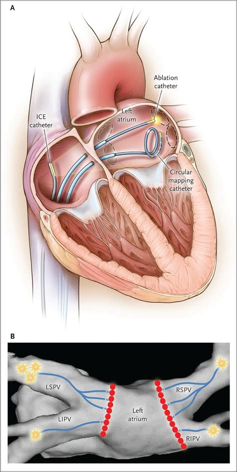 Catheter Ablation for Atrial Fibrillation | NEJM