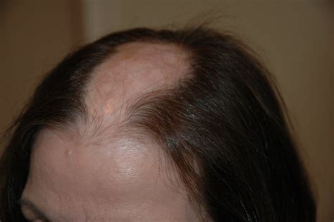 Scarring Alopecia – Aderans Hair Centre