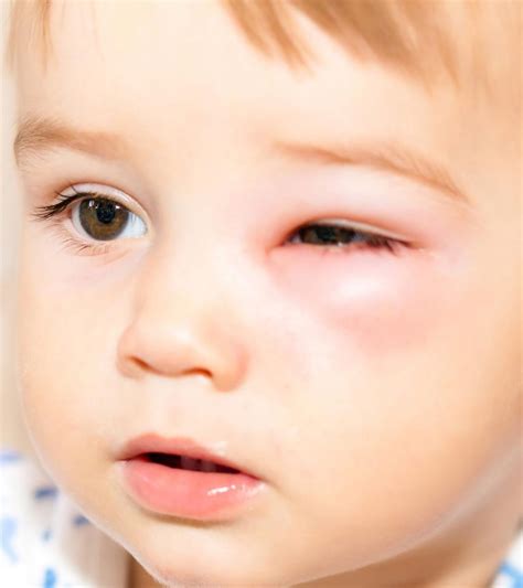 Symptoms And Causes Of Periorbital Cellulitis In Children