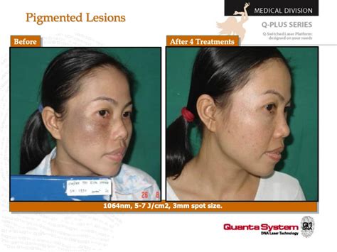 Melasma Treatment San Francisco: Cost, Risks, Before & After