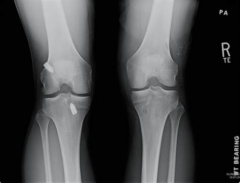 x-ray of my knees | My left knee had ACL surgery in 2004, an… | Flickr