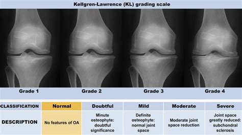 The KL grading system to assess the severity of knee OA. | Download ...